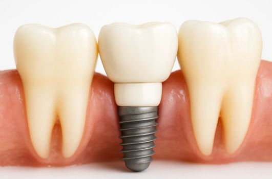 Ilustração de implante dentário unitário com coroa entre dois dentes naturais.