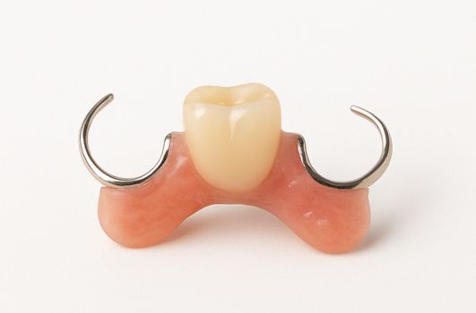 Prótese parcial removível com um dente artificial e grampos metálicos de apoio.